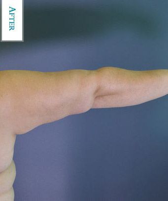 After arm lift surgery